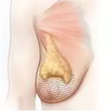 Reductia tesutului mamar